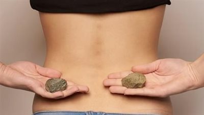 دون علاجات.. 4 طرق سهلة وفعالة للوقاية من حصى الكلى 