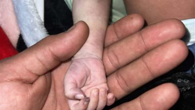 تميم طفل رضيع يواجه شللا جزئيا بمستشفى الخانكة.. «ركبوله كانيولا غلط»
