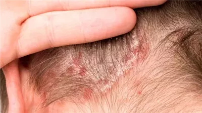 علاج أكزيما الشعر.. كيفية تهدئة وعلاج التهاب فروة الرأس بشكل طبيعي؟