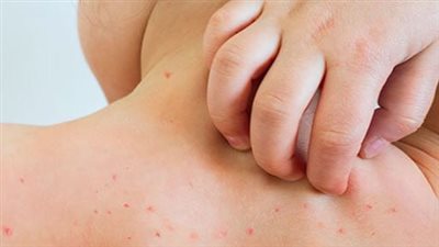 تفشي الحصبة.. علامات تحذيرية مبكرة لدى الأطفال وطرق حمايتهم