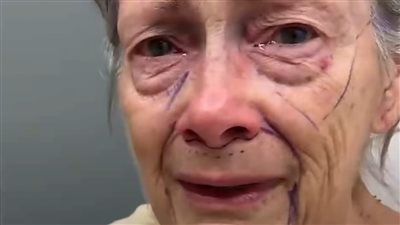 جراح تجميل يعيد لامرأة سبعينية شبابها بعد عملية شد الوجه 