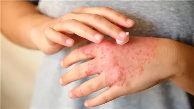 دراسة علمية.. الإجهاد النفسي والتوتر يجعل الإكزيما أسوأ