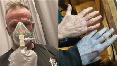 استيقظ أزرق بالكامل..خطأ بسيط يدخل بريطاني في كارثة طبية