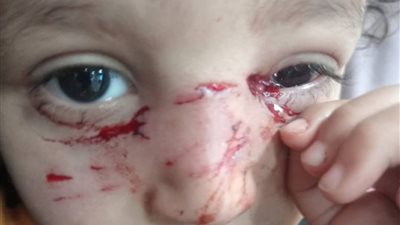 إصابات خطيرة بالوجه والعين.. كلب ضال يهاجم طفلاً في مدينة السويس 