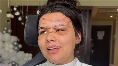 عملت حادثة قبل الفرح بـ 5 أيام.. خبيرة تجميل تنقذ عروس في يومها