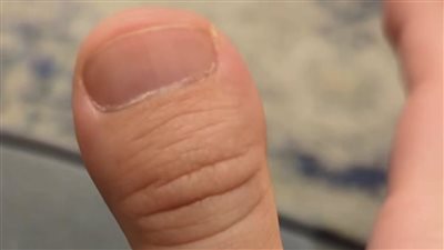 سبب جيني.. تعرف على الأسباب الطبية وراء إصابتك بإصبع 
