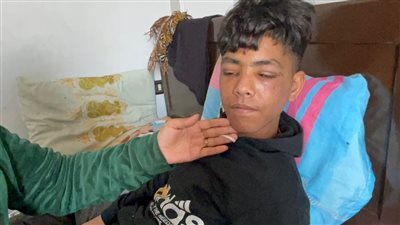 مواطن بالمنوفية يطفأ السجائر فى وجه طفل بعد مشاجرة مع نجله 
