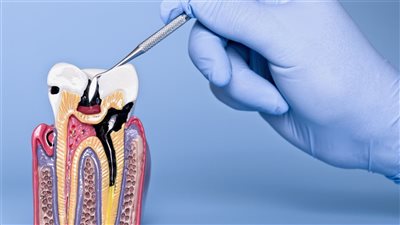 مخاطر خفية.. أسباب تآكل الأسنان التدريجي والأعراض والعلاج