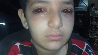 مطالبات بمحاسبة المسؤولين بعد إصابة طالب فى عينه نتيجة اعتداء داخل مدرسة