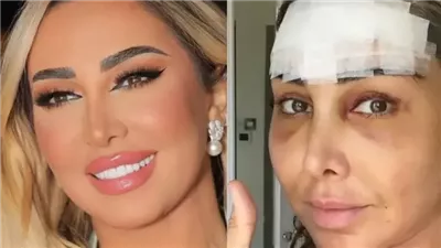 جويل ماردينيان تعيد تسليط الضوء على عمليتها لشد الوجه 