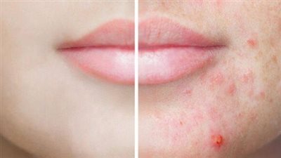 وصفة لحبوب الوجه.. خطوات طبيعية لبشرة صافية ومشرقة