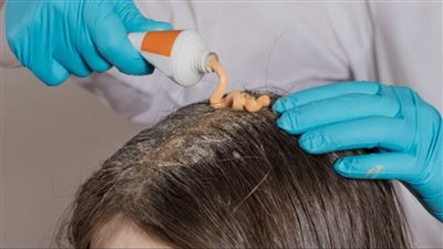 هل تقلل زيوت الشعر من قشرة الشعر؟ خبيرة تجيب|خاص.. اليكي التفاصيل 