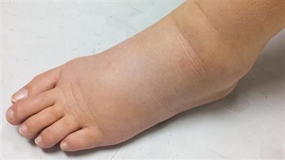 التورم وعدم الشعور بالراحة..أمراض يسببها احتباس الماء 