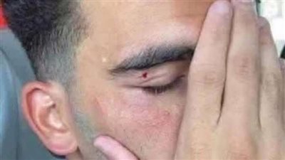 إصابة في الوجه.. صورة «زيزو» تثير الجدل على «السوشيال ميديا»