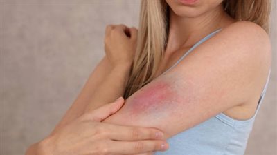 من حب الشباب إلى حروق الشمس.. طبيبة تحدد 11 سببًا لـ أحمرار الجلد