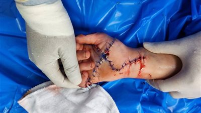 «إنجاز طبي بسوهاج».. فريق جامعي ينقذ حياة فتاة ويدها من البتر الكامل 