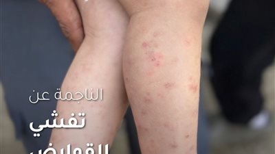 الفئران تنهش أطفال غزة داخل الخيام وأونروا تحذر من انهيار صحي 
