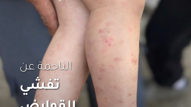 الفئران تنهش أطفال