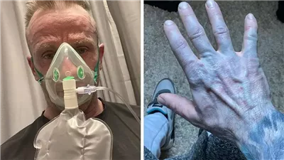 حالة غريبة في الطوارئ.. رجل يتحول لـ الأزرق بسبب ملاءات السرير