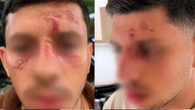 ظننت أنني سأموت.. تعرض إسرائيلي للضرب في لندن بعد تحدثه بالعبرية