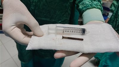 إنقاذ طفلة ابتلعت «مسمارًا» بطول 10 سم داخل مستشفيات جامعة الزقازيق