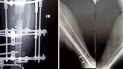 نجاح جراحة نادرة لإعادة بناء عظمة ساق مريضة داخل الكرنك الدولي بالأقصر