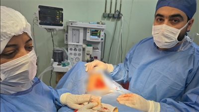 نجاح استئصال تضخم بالغدة الدرقية ممتد للتجويف الصدري بمستشفى الجمالية المركزي 