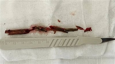  دون علمه|رجل يعيش مع غصن خشبي طوله 5 بوصات في تجويف عينه