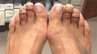 ظاهرة جديدة في عالم التجميل هذا الصيف.. عملية تقصير أصابع القدم 