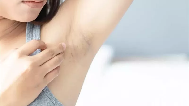 اسمرار الإبطين في