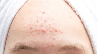 7 أسباب لظهور الحبوب الصغيرة على الجبهة في الصيف وطرق التعامل معها