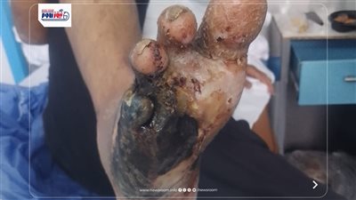 استغاثة مريض قدم سكري بالفيوم: أجريت كل الإجراءات والجراحة تتأجل للمرة الثانية