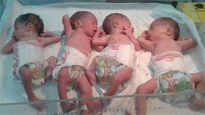 ولادة نادرة في أستراليا.. أربعة توائم متطابقات من بويضة واحدة