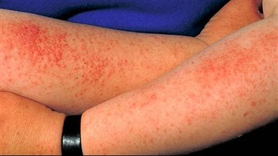 أمراض جلدية يفاقمها الصيف.. استشارية تكشف أبرز المخاطر وطرق الوقاية