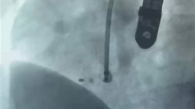 دون تدخل جراحي.. إجراء 3 عمليات دقيقة لأطفال بمستشفى سوهاج الجامعي