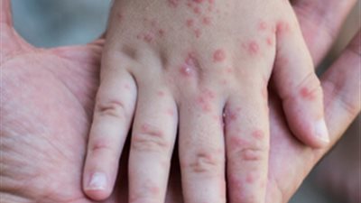 بعد انتشارها بالولايات المتحدة .. برلمانيون : مصر خالية من وباء الحصبة