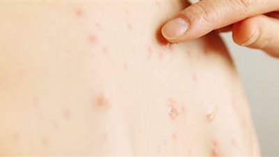 بعد خلوها... كيف واجهت مصر الحصبة الألمانية وفيروس سي؟