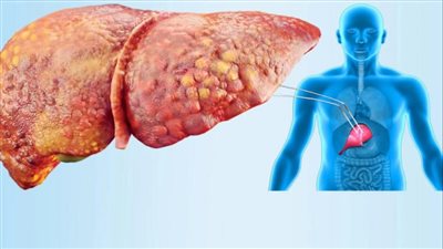 8 مشروبات طبيعية لتقليل دهون الكبد في أسبوعين فقط.. تفاصيل