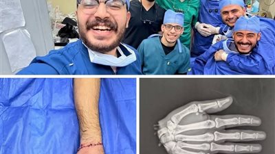 أطباء بـ طب الأزهر ينجحون في إنقاذ يد شاب بعد بترها