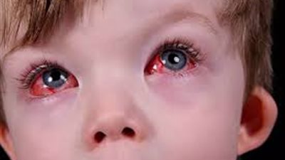 النيابة تحقق في واقعة تكحيل 3 أطفال بـ الحناء في كفرالشيخ