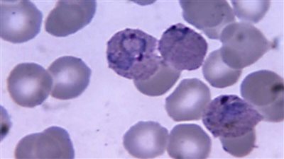 فى اليوم العالمي للملاريا 2025… تعرف على أعراض المرض القاتل وطرق الوقاية