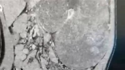 أطباء مستشفى الباجور ينقذون طفلة من الموت المحقق بعد استئصال ورم خطير بالكلى