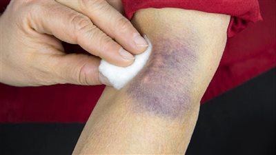 أسباب ظهور الكدمات الزرقاء بصورة مفاجئة