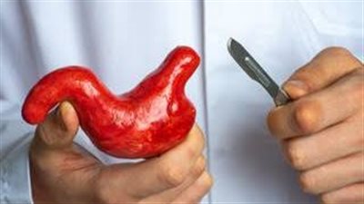 جلطات ومضاعفات .. مخاطر غير متوقعة لعمليات التكميم 