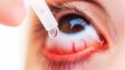 تجنب العدسات اللاصقة.. 6 نصائح لحماية العين من غبار الربيع وحبوب اللقاح 