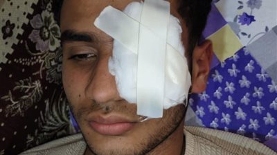 شاب يفقد عينه في مشاجرة داخل سيارة نقل عمالة بطنطا