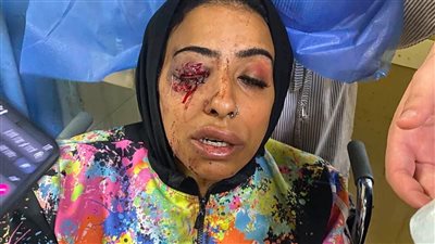 استغاثة عاجلة لإنقاذ موظفة بدمياط بعد إصابتها في اعتداء أفقدها عينها اليمنى