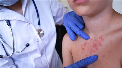الولايات المتحدة تواجه خطر عودة الحصبة.. بنسلفانيا تسجل أول وفيات منذ 35 عامًا
