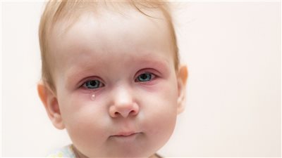 طبيب عيون يوضح أسباب الرمد الربيعي عند الأطفال وطرق علاجه