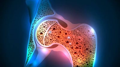 بارقة أمل.. دراسة ثورية تُحدد مسارات جينية جديدة لعلاج هشاشة العظام